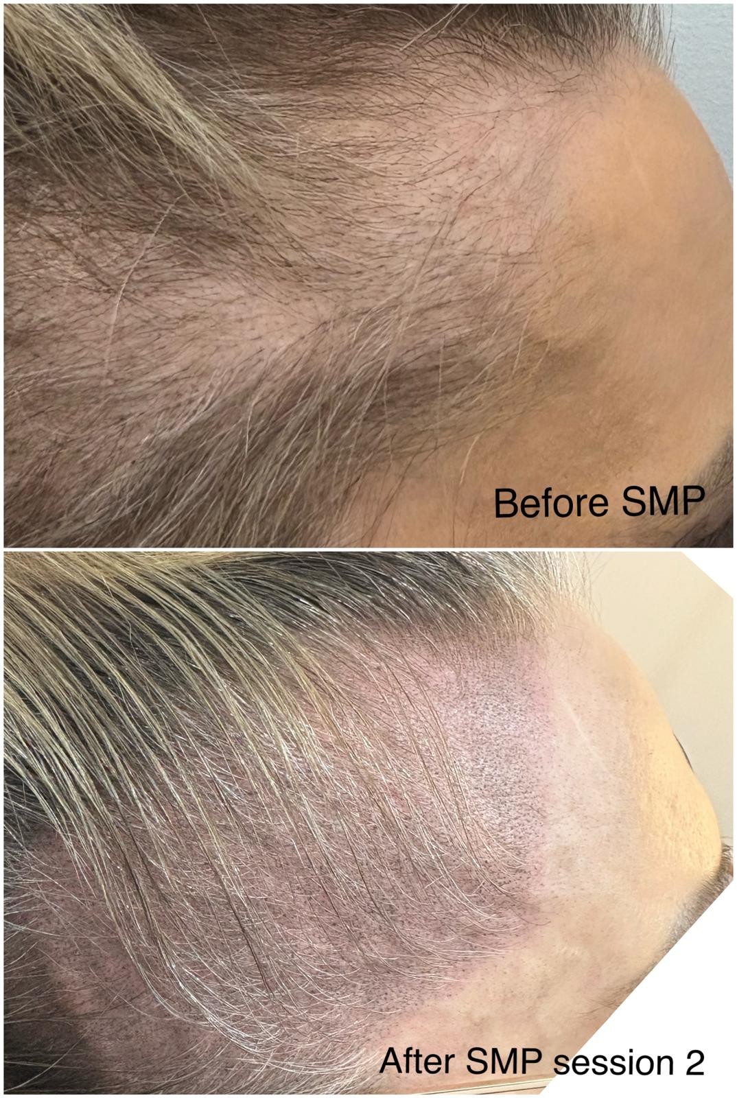 Alopecia SMP 2-min