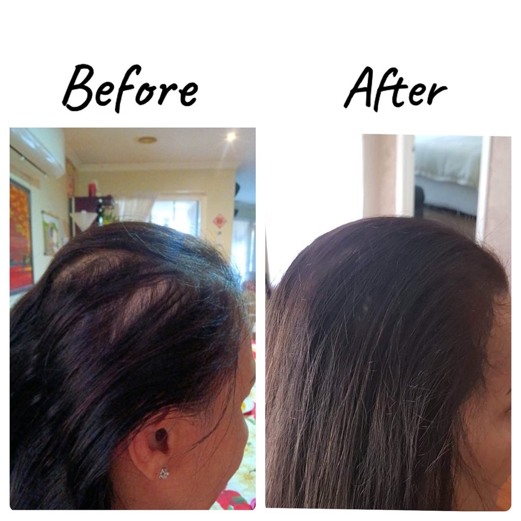 Alopecia SMP 3-min