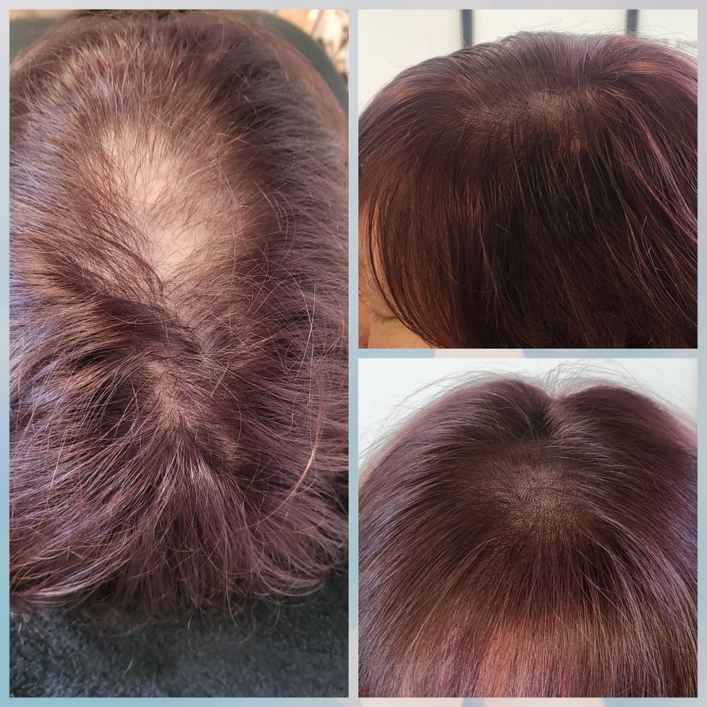 Alopecia SMP 4-min