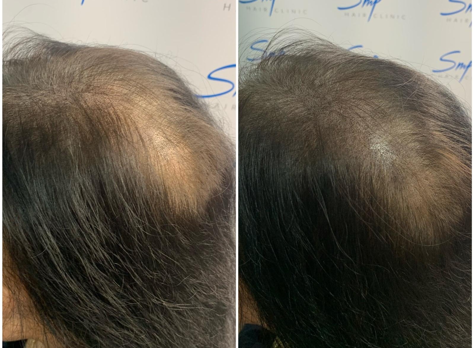 Alopecia SMP 5-min