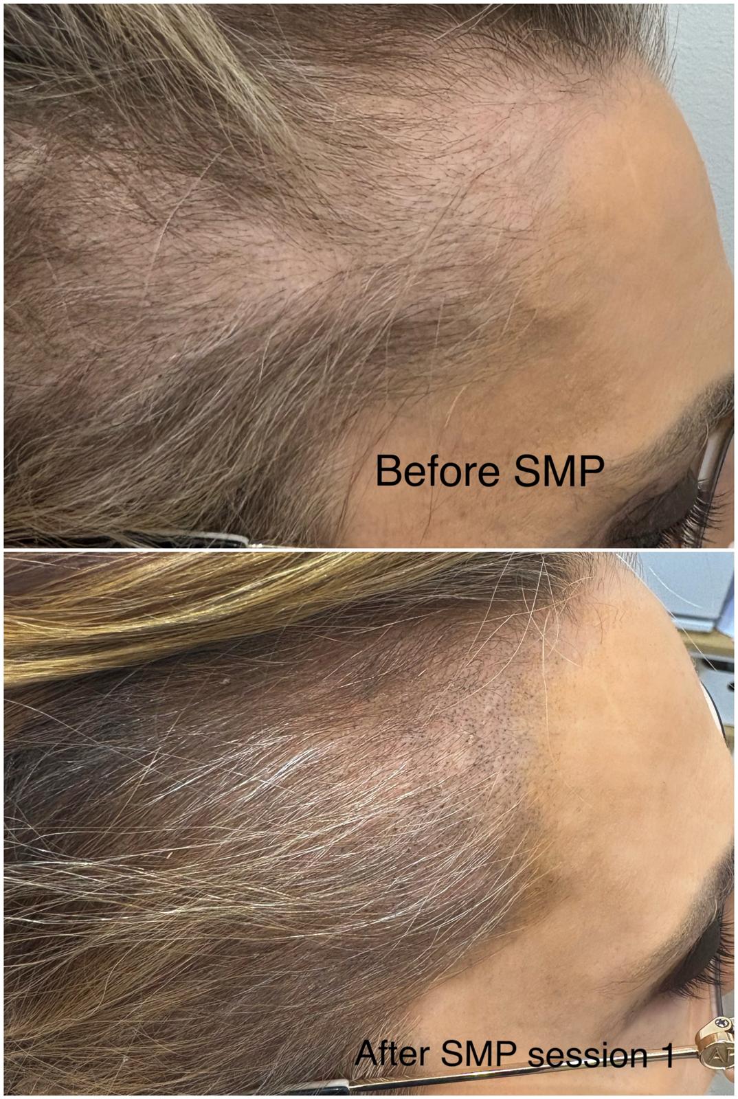 Alopecia SMP 6-min